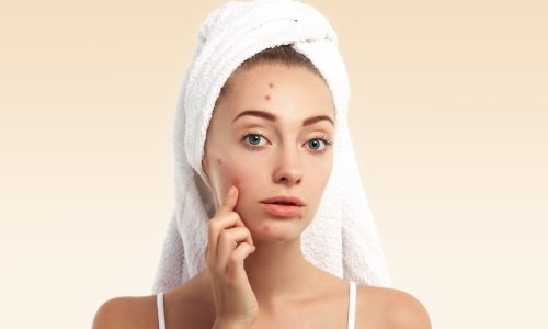 Acne: Causas Tratamentos e cuidados essenciais